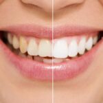 Teeth Whitening In Assamese